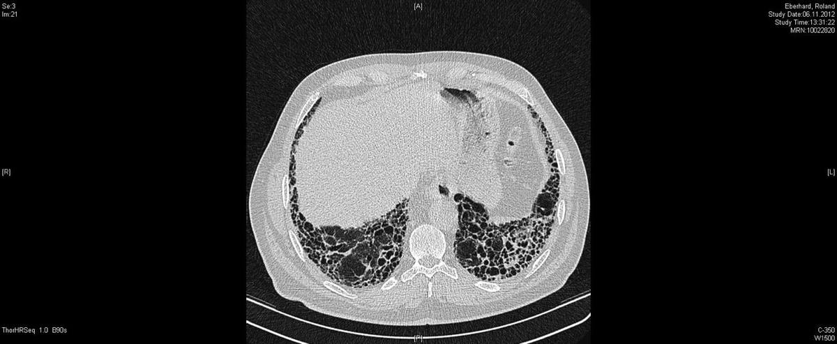 Corte de tomografia de alta resolução do tórax com sinais de fibrose pulmonar